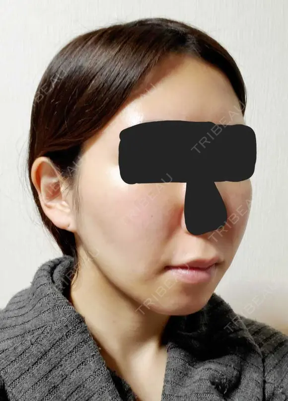 糸リフト / バッカルファット除去 / 脂肪吸引（顔） / ジョールファット除去 / ボトックス（エラ・小顔） アリエル美容クリニック 大宮院 DAY 97 メイン用