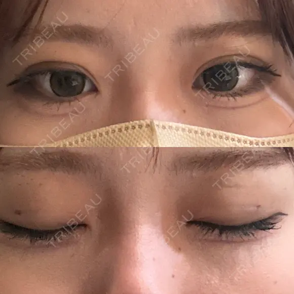 二重埋没 / 上まぶたの脂肪取り アリエル美容クリニック 横浜院 DAY 3 メイン用