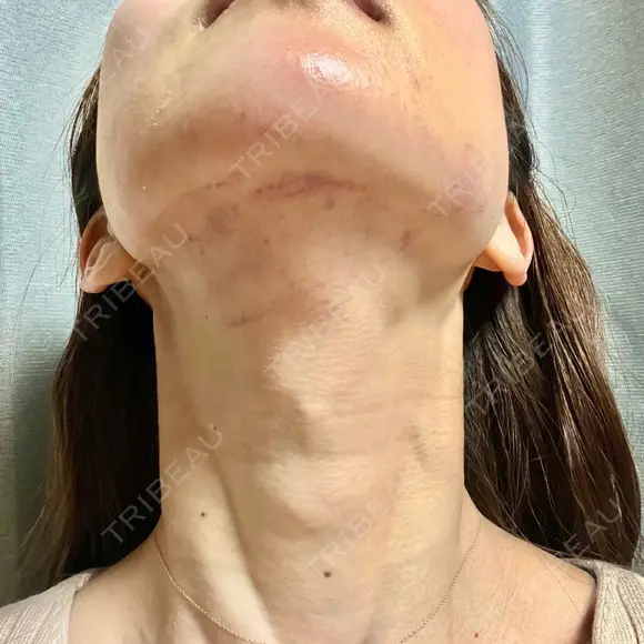 RF（高周波）たるみ治療 TUNE CLINIC【チューンクリニック】 DAY 0 メイン用