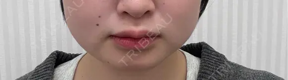 ボトックス（エラ・小顔） / 脂肪溶解注射（顔） / ボトックス（肩） TCB東京中央美容外科 長野院 AFTER メイン用