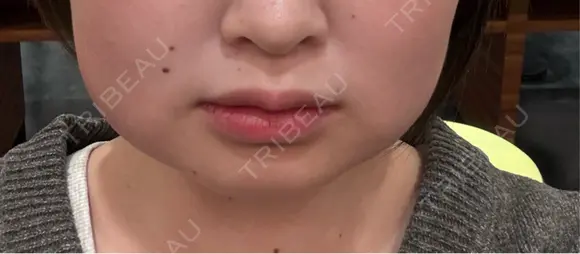 ボトックス（エラ・小顔） / 脂肪溶解注射（顔） / ボトックス（肩） TCB東京中央美容外科 長野院 DAY 1 メイン用