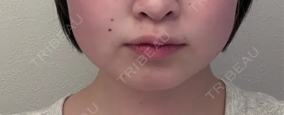 ボトックス（エラ・小顔） / 脂肪溶解注射（顔） / ボトックス（肩） TCB東京中央美容外科 長野院 DAY 1 メイン用