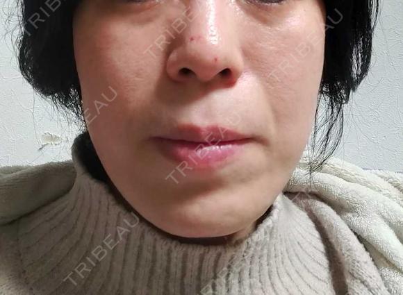 RF（高周波）たるみ治療 OMC 表参道院 DAY 37 メイン用