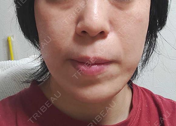 RF（高周波）たるみ治療 OMC 表参道院 DAY 47 メイン用