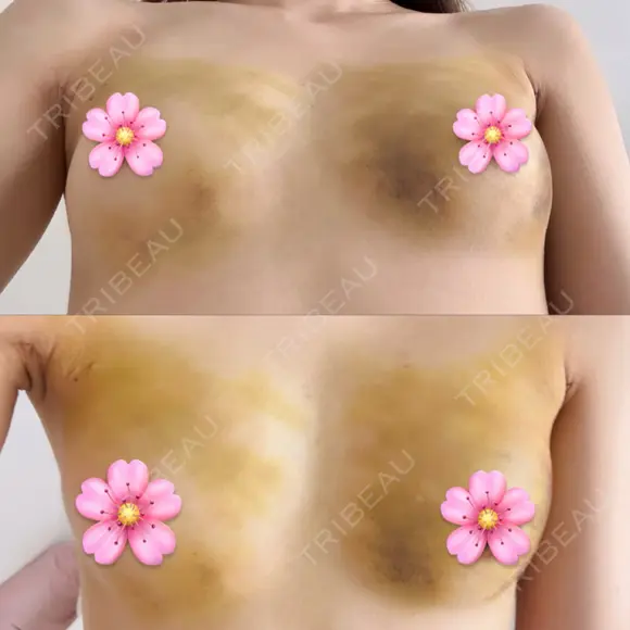 豊胸（脂肪注入） 湘南美容クリニック 吉祥寺院 AFTER メイン用