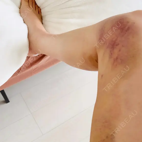 豊胸（脂肪注入） 湘南美容クリニック 吉祥寺院 DAY 4 メイン用