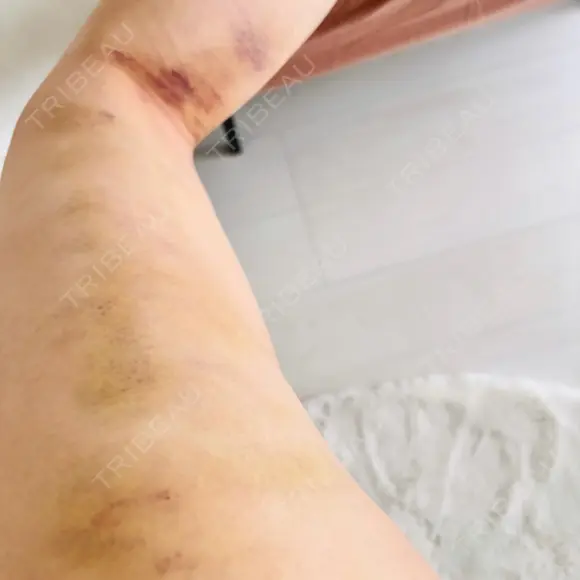 豊胸（脂肪注入） 湘南美容クリニック 吉祥寺院 DAY 4 メイン用