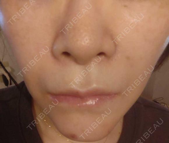 脂肪溶解注射（顔） / ヒアルロン酸注入（鼻翼基部） / ヒアルロン酸注入（ほうれい線） 目白ホワイトクリニック DAY 5 メイン用