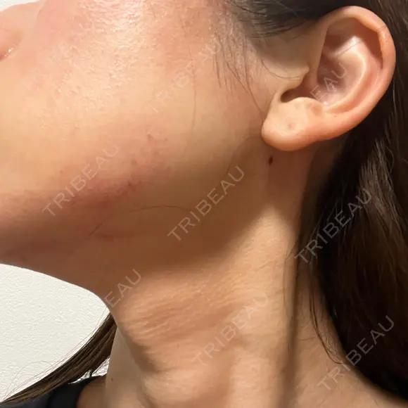 RF（高周波）たるみ治療 TUNE CLINIC【チューンクリニック】 DAY 1 メイン用