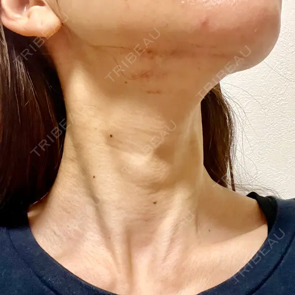 RF（高周波）たるみ治療 TUNE CLINIC【チューンクリニック】 DAY 1 メイン用