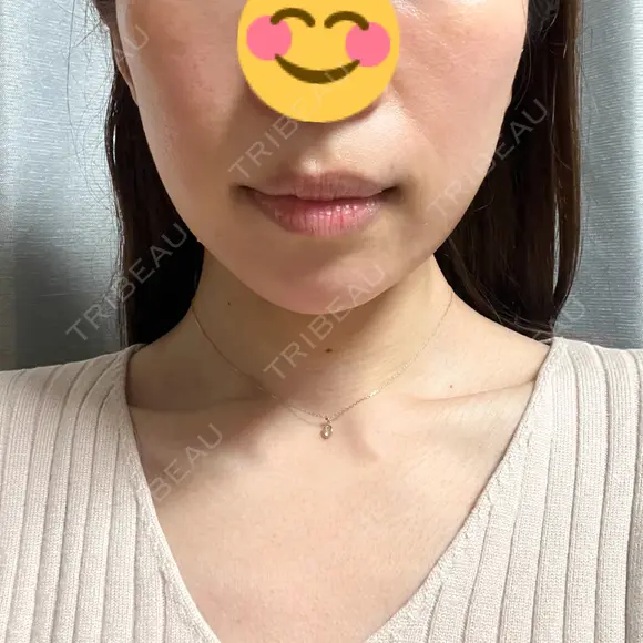 RF（高周波）たるみ治療 TUNE CLINIC【チューンクリニック】 DAY 0 メイン用