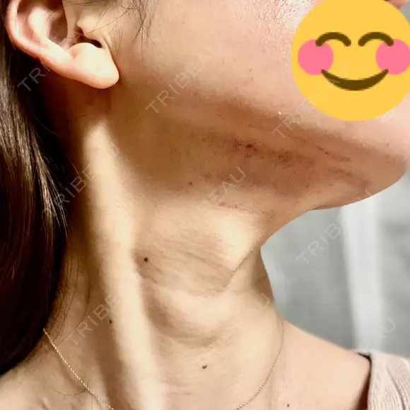 RF（高周波）たるみ治療 TUNE CLINIC【チューンクリニック】 DAY 0 メイン用