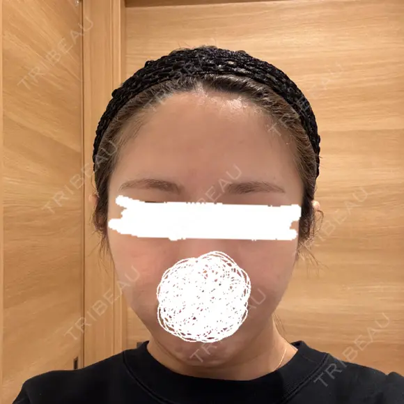 脂肪注入（額） EMMA CLINIC（エマクリニック） AFTER メイン用