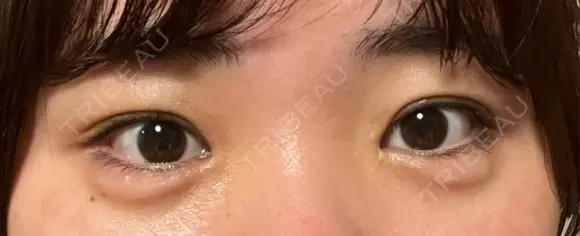 ヒアルロン酸注入（涙袋） AZ BEAUTY CLINIC DAY 1 メイン用