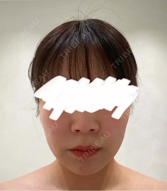 脂肪吸引（顔） / 脂肪吸引（二の腕） Mods Clinic（モッズクリニック） 福岡院 DAY 90 メイン用