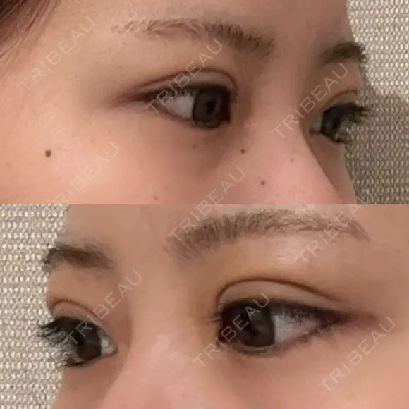 二重埋没 / 上まぶたの脂肪取り アリエル美容クリニック 横浜院 DAY 4 メイン用