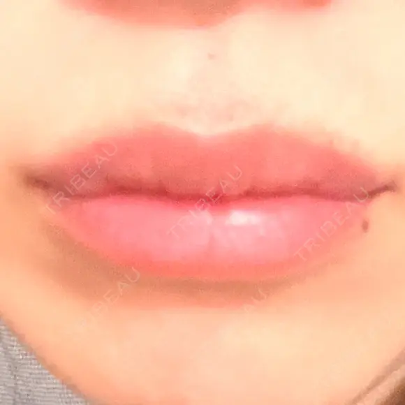 ヒアルロン酸注入（唇） アネシス美容クリニック DAY 2 メイン用