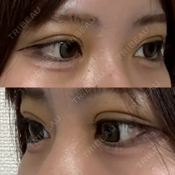 二重埋没 / 上まぶたの脂肪取り アリエル美容クリニック 横浜院 DAY 5 メイン用