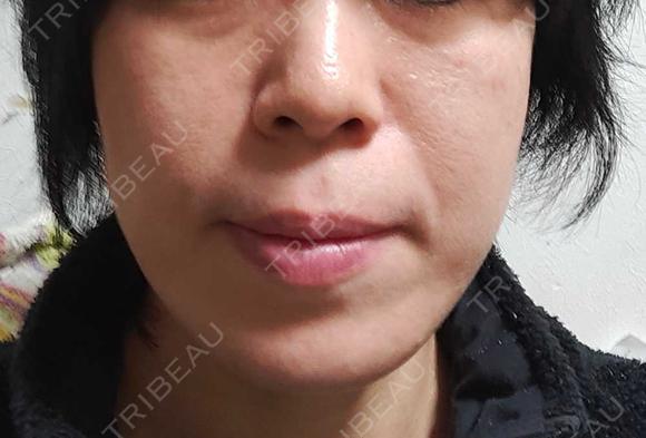 RF（高周波）たるみ治療 OMC 表参道院 AFTER メイン用