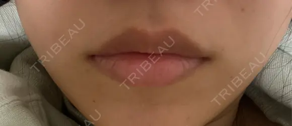 ボトックス（口角） DMTC CLINIC 日本橋院 DAY 1 メイン用