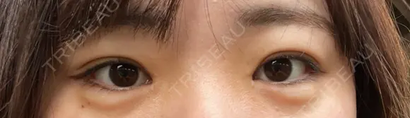 ヒアルロン酸注入（涙袋） AZ BEAUTY CLINIC DAY 3 メイン用