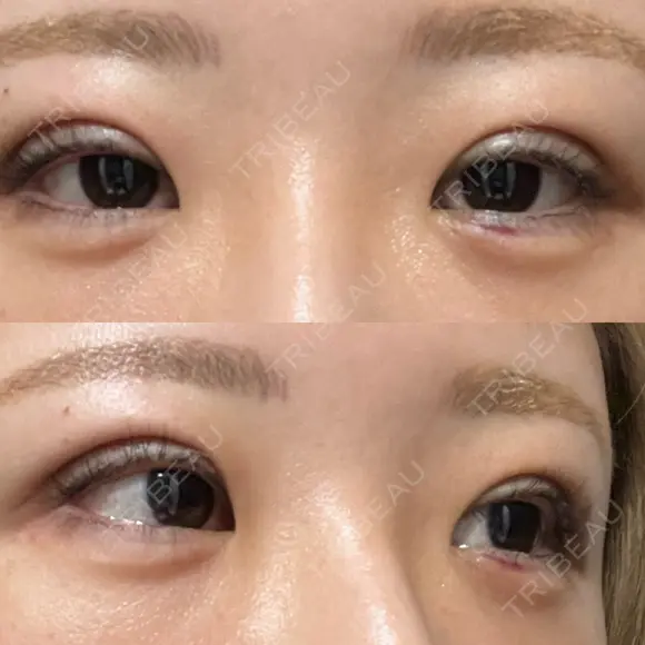 二重埋没 / ヒアルロン酸注入（涙袋） EMMO FACE CLINIC 東京三田院 DAY 1 メイン用