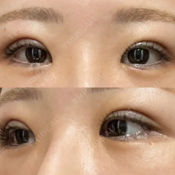 二重埋没 / ヒアルロン酸注入（涙袋） EMMO FACE CLINIC 東京三田院 DAY 1 メイン用