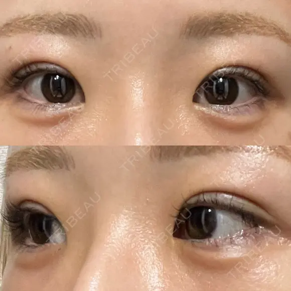 二重埋没 / ヒアルロン酸注入（涙袋） EMMO FACE CLINIC 東京三田院 DAY 31 メイン用