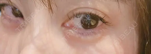 ヒアルロン酸注入（涙袋） ネビュラクリニック 東京錦糸町院 DAY 3 メイン用