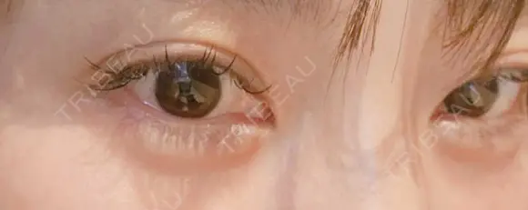 ヒアルロン酸注入（涙袋） ネビュラクリニック 東京錦糸町院 DAY 4 メイン用