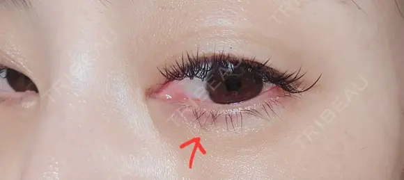 ヒアルロン酸注入（涙袋） ネビュラクリニック 東京錦糸町院 DAY 6 メイン用