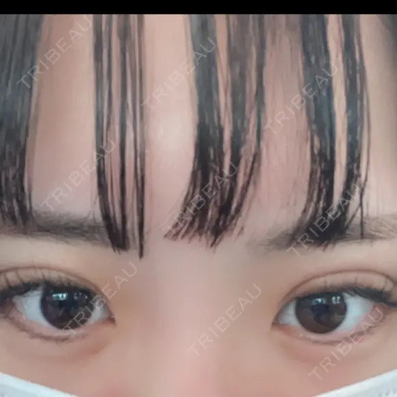 ヒアルロン酸注入（涙袋） アネシス美容クリニック AFTER メイン用