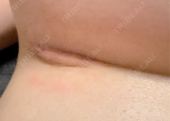 脂肪吸引（二の腕） / 脂肪吸引（脚） / 豊胸（シリコンバッグ） / 豊胸（脂肪注入） / 胸修正 / 豊胸（シリコン＋脂肪併用） ヴェルトラクリニック 新宿院 DAY 15 メイン用