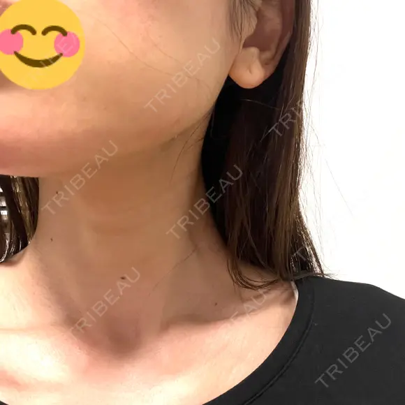 RF（高周波）たるみ治療 TUNE CLINIC【チューンクリニック】 DAY 4 メイン用