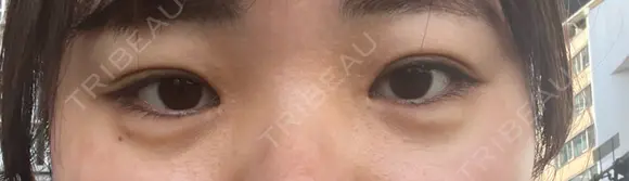 ヒアルロン酸注入（涙袋） AZ BEAUTY CLINIC DAY 4 メイン用