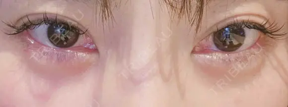 ヒアルロン酸注入（涙袋） ネビュラクリニック 東京錦糸町院 DAY 7 メイン用