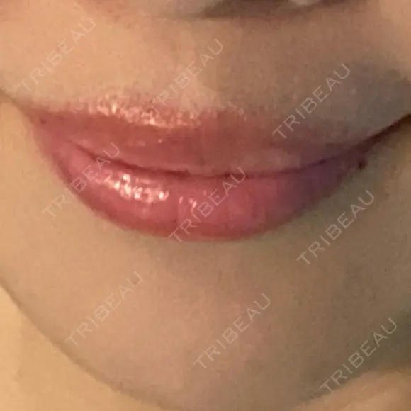 ヒアルロン酸注入（唇） アネシス美容クリニック DAY 3 メイン用