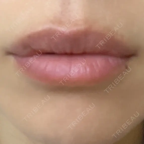 ヒアルロン酸注入（唇） アネシス美容クリニック DAY 4 メイン用