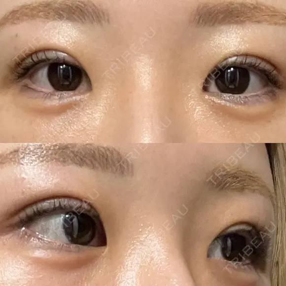 二重埋没 / ヒアルロン酸注入（涙袋） EMMO FACE CLINIC 東京三田院 DAY 31 メイン用