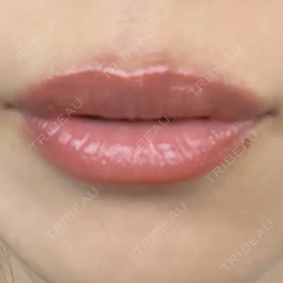 ヒアルロン酸注入（唇） アネシス美容クリニック DAY 5 メイン用