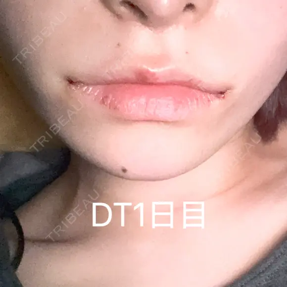 口角挙上 / ボトックス（人中） LOUIS CLINIC 二子玉川院【ルイクリニック】 DAY 1 メイン用