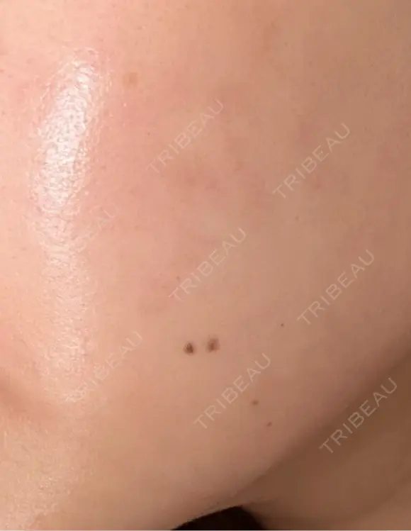 その他（肌） / 美肌レーザー こまちクリニック DAY 24 メイン用