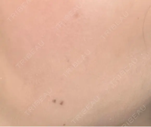 その他（肌） / 美肌レーザー こまちクリニック AFTER メイン用