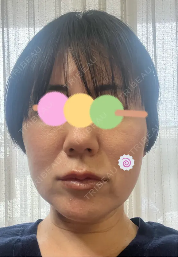 糸リフト Olino美容外科・美容皮膚科 DAY 57 メイン用