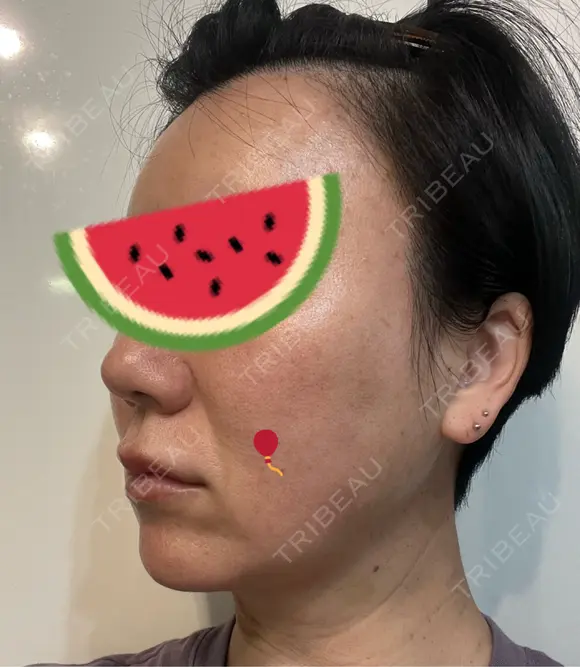 糸リフト Olino美容外科・美容皮膚科 DAY 64 メイン用