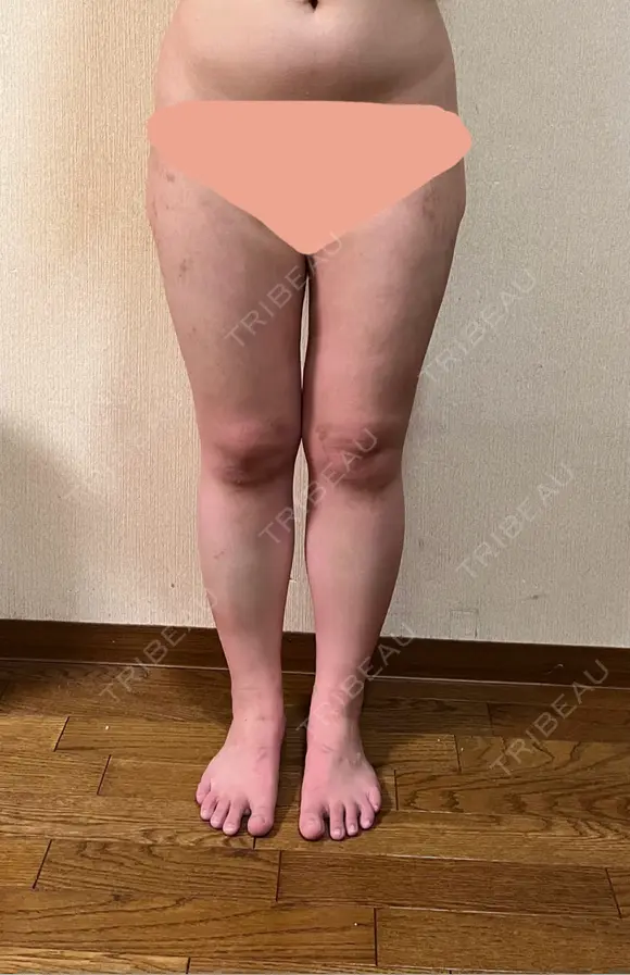 脂肪吸引（脚） Mods Clinic（モッズクリニック） 大阪院 DAY 22 メイン用