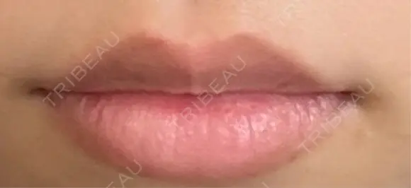 ボトックス（口角） DMTC CLINIC 日本橋院 AFTER メイン用