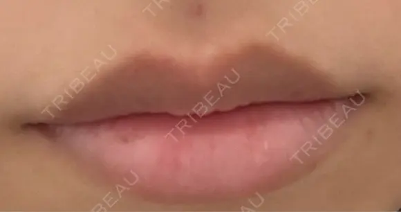 ボトックス（口角） DMTC CLINIC 日本橋院 DAY 0 メイン用