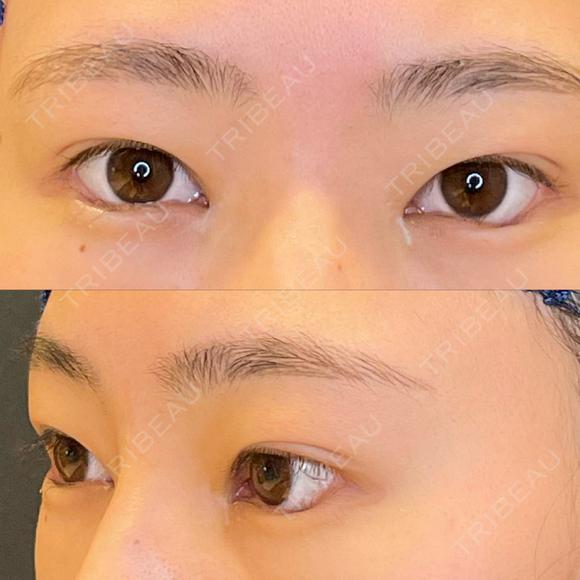 タレ目形成・グラマラスライン（埋没） LOUIS CLINIC 二子玉川院【ルイクリニック】 AFTER メイン用