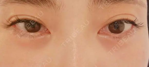 ヒアルロン酸注入（涙袋） ネビュラクリニック 東京錦糸町院 DAY 8 メイン用